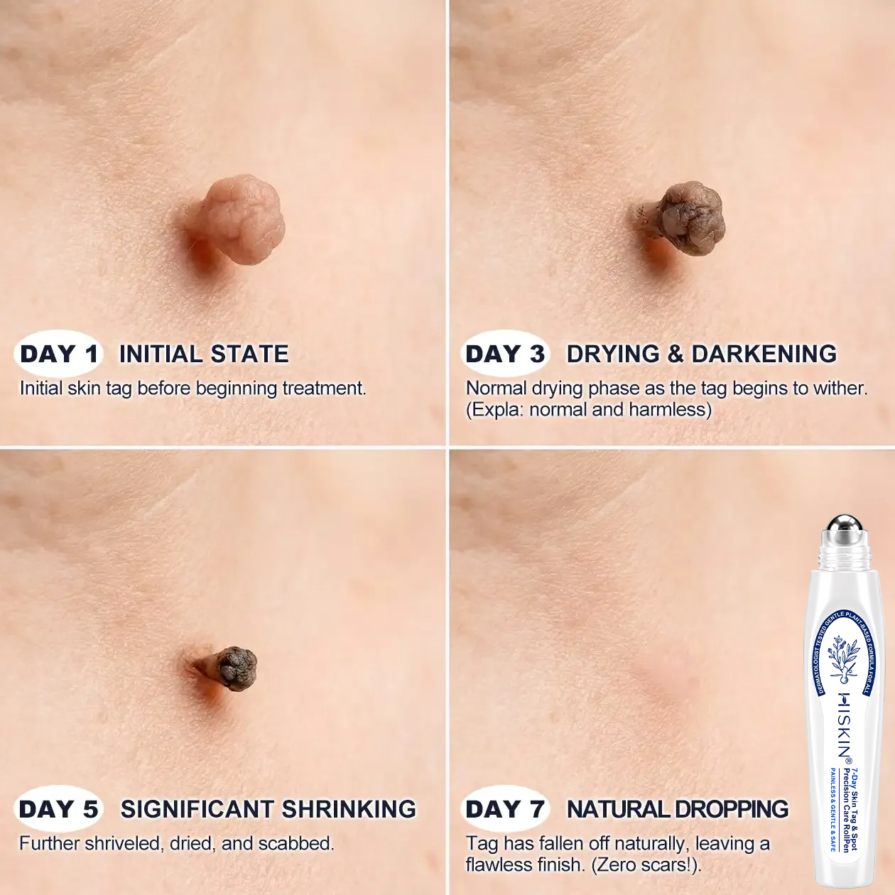 🎁 Only a few 𝐇𝐈𝐒𝐊𝐈𝐍® Wart Removal Pens left — enjoy an extra 30% OFF today! ✨ Easily target unwanted warts from the comfort of your home and support smoother, clearer-looking skin. Don't miss out—this limited-time offer won't be back anytime soon!
